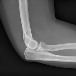 FractSure elbow X-ray